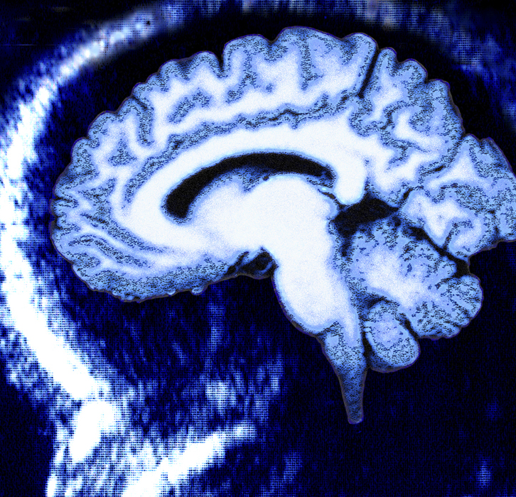 MRI of the Brain - Neurosequential Model of Therapeutics (NMT)